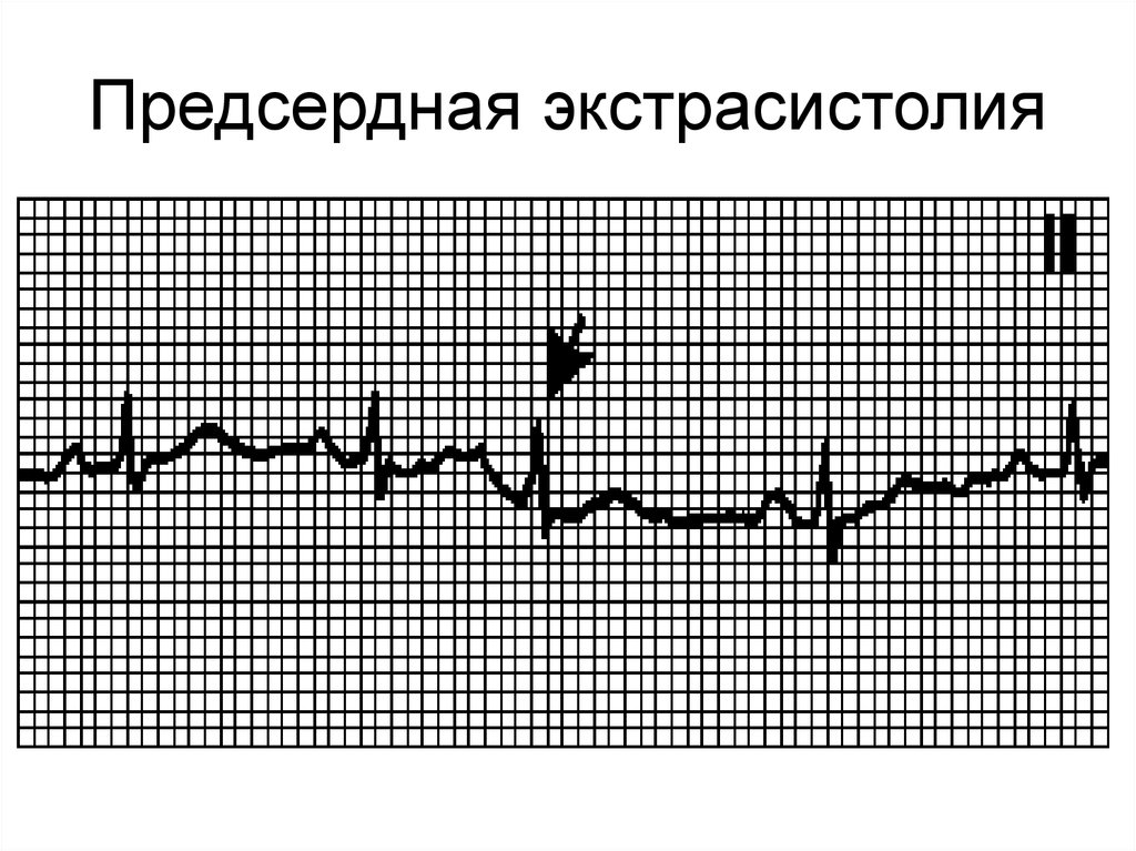 10 экстрасистола