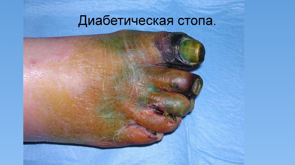 Диабетическая стопа.