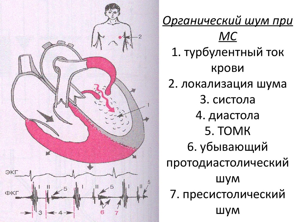 Сердце метода. Перикардиальные шумы. Диастола желудочков за год. Турбулентный ток крови. Перикардиальный шум сердца.