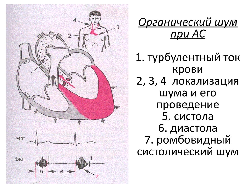 Что такое систола сердца. Систола и диастола на ЭКГ. Давление в полостях сердца у детей. Пороки сердца по кардиограмме. Систола на ФКГ.