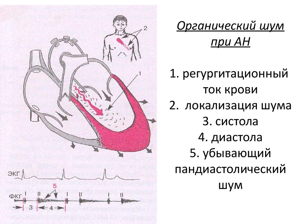 Аортальная недостаточность презентация