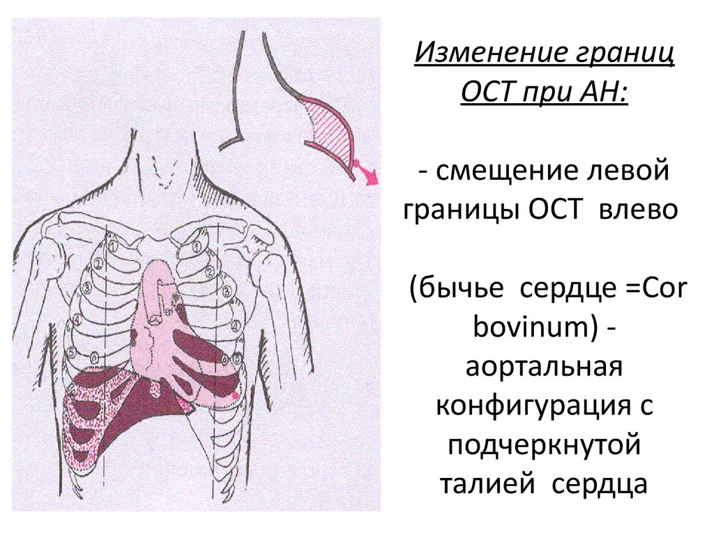 Конфигурация сердца аортальная схема