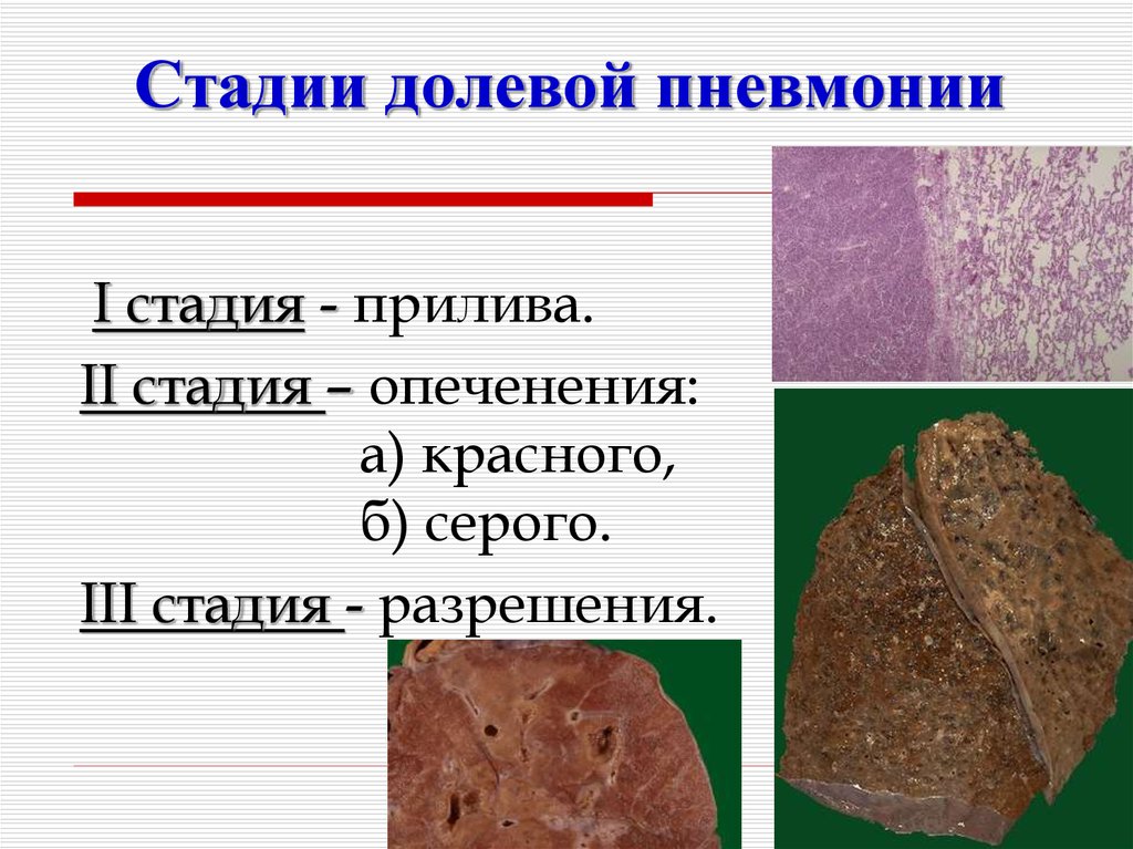 Стадии пневмонии. Стадия опеченения при долевой пневмонии. Стадия серого опеченения при долевой пневмонии. Стадии опеченения это пневмония. Стадия прилива красного опеченения серого опеченения разрешения.