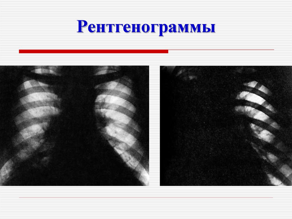 Карта смп пневмония внебольничная