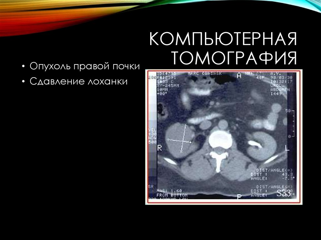 Образование правого. Объемное образование правой почки. Опухоль лоханки почки кт. Опухоль почечной лоханки кт.