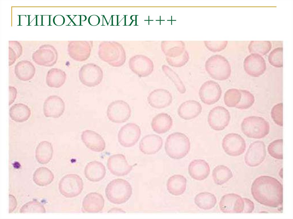 Гипохромия железодефицитная анемия. Гипохромная анемия мазок крови. Нормохромия гипохромия гиперхромия. Гипохромная анемия картина крови. Гипохромная анемия эритроциты.