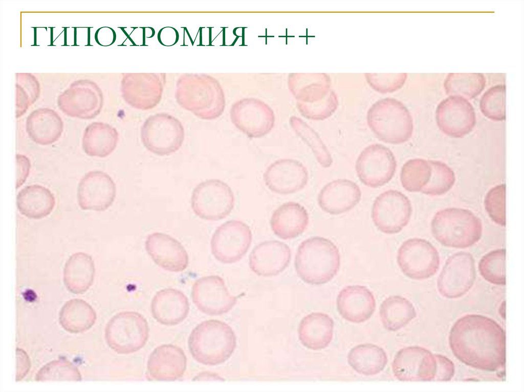 Гипохромия. Гипохромная анемия мазок крови. Гипохромия эритроцитов анизохромия. Гипохромия гиперхромия нормохромия. Гипохромная анемия картина крови.