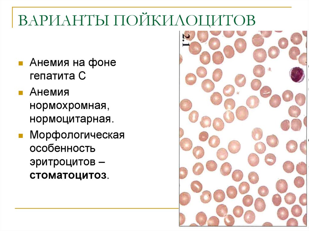 Анемия и эритроциты в крови. Нормохромная гиперрегенераторная микроцитарная анемия. Нормохромная и гипохромная анемия. Нормоцитарные анемии классификация. Нормохромная анемия картина крови.