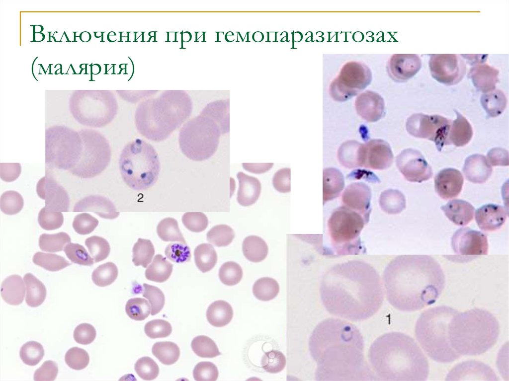 Кровь на малярию. Малярия картина крови. Зернистость эритроцитов при малярии. Включения эритроцитов при малярии. Мазок крови больного малярией.