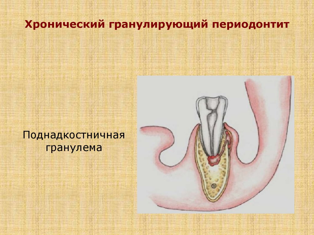 Этиология и патогенез апикального периодонтита презентация