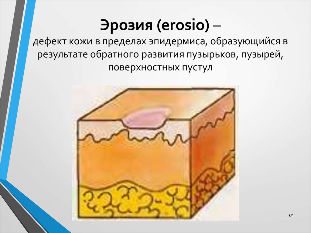 Пятно элемент сыпи. Морфологические элементы кожи эрозия. Первичные морфологические элементы кожи. Вторичные морфологические элементы кожи. Дефект кожи в пределах эпидермиса.