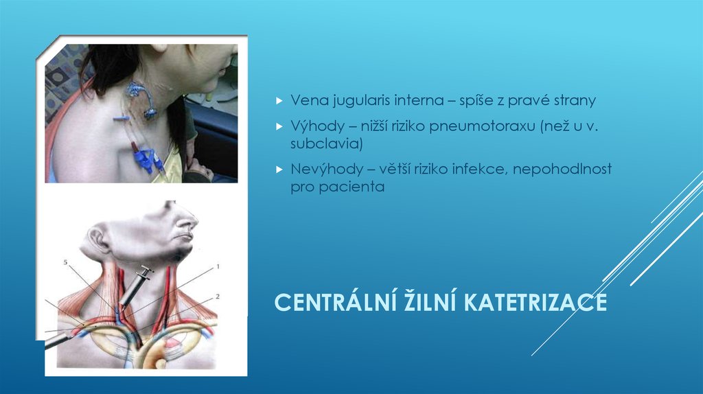 CENTRÁLNÍ ŽILNÍ KATETRIZACE