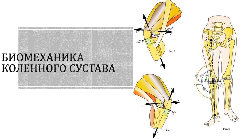 Артроскопия коленного сустава. Разрыв ПКС.