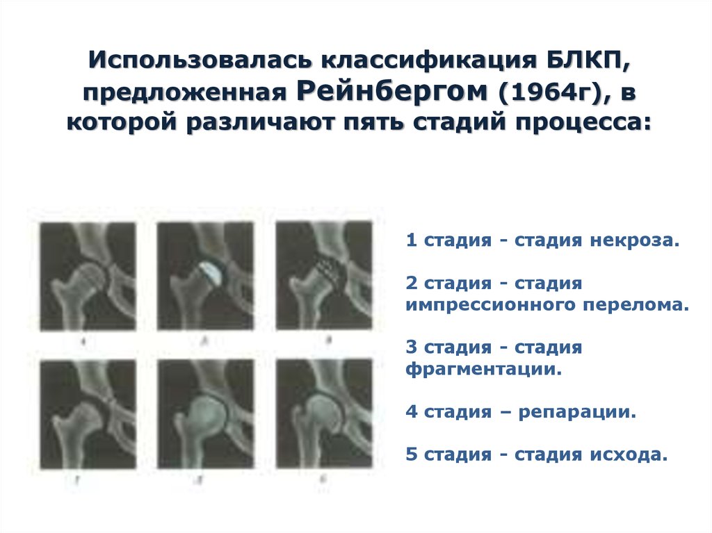 Импрессионный перелом головки бедренной кости. Болезнь Легга-Кальве-Пертеса , 2 стадии. Болезнь Легга Кальве Пертеса рентгенологические стадии. Болезнь Пертеса 1 стадия рентген.