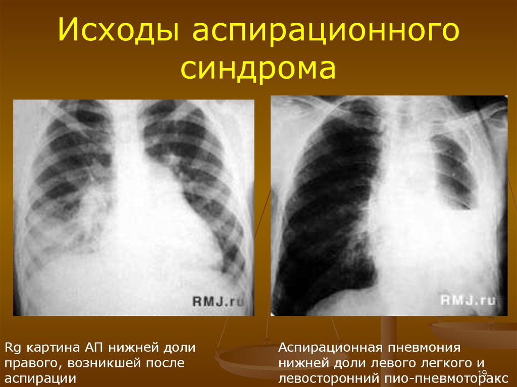 Аспирационная пневмония