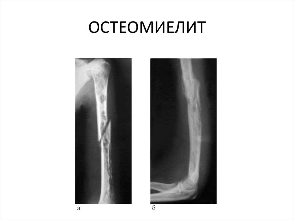 Остеомиелит кости