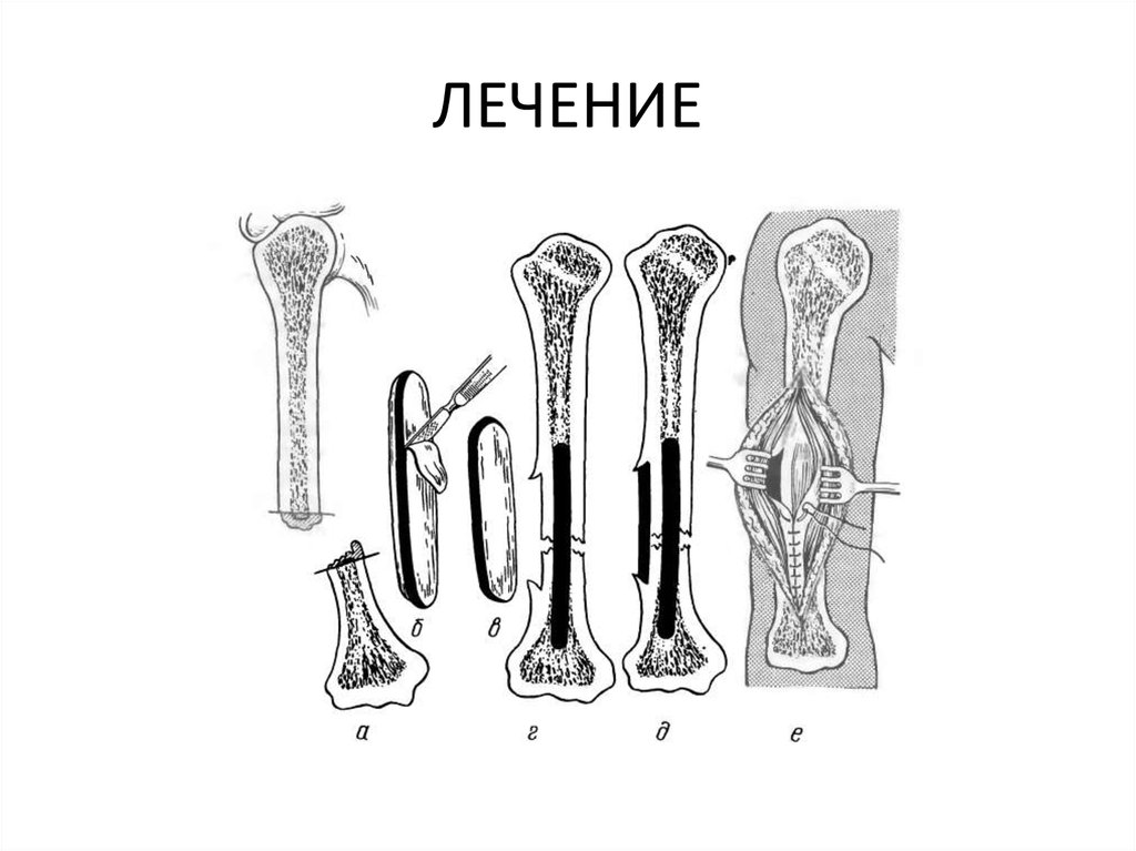 Тело длинные трубчатые кости