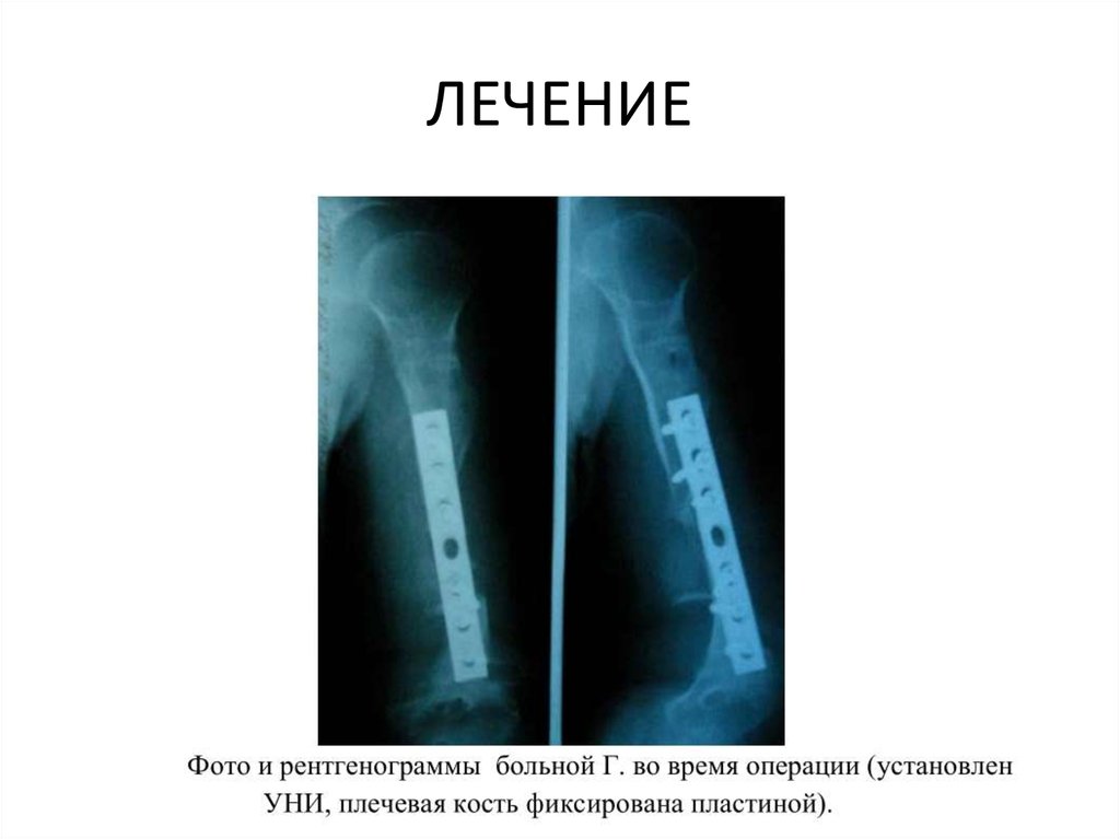 Укорочение трубчатых костей. Укорочение длины трубчатых костей. Рентгенография длинных трубчатых костей. Укорочение трубчатых костей на 3 недели. Укорочение трубчатых костей форум.