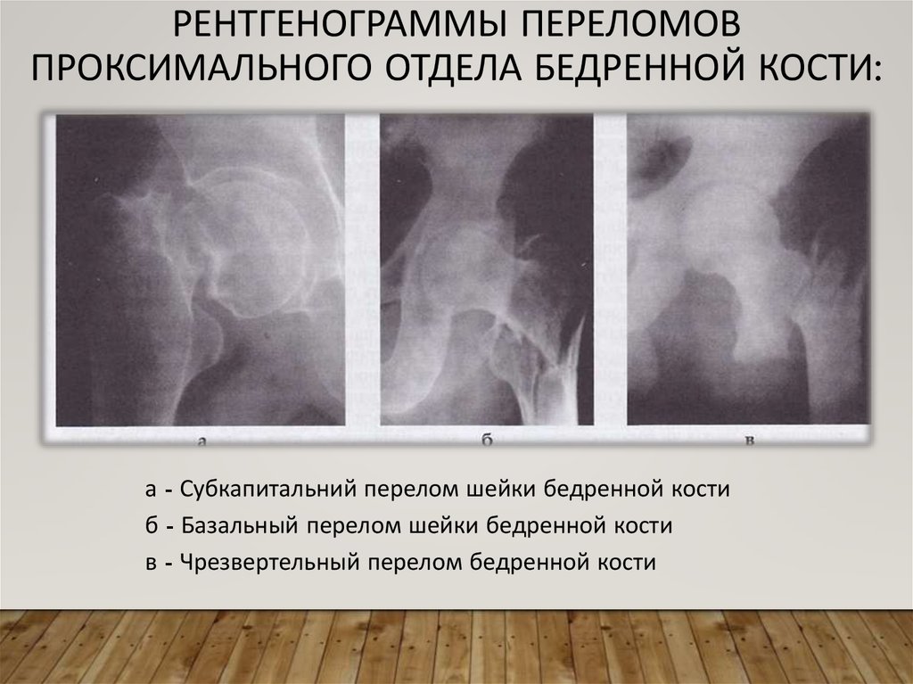 Перелом бедренной кости клинические рекомендации тесты нмо. Переломы шейки бедра классификация рентген. Перелом проксимального отдела бедра рентген. Субкапитальный перелом шейки бедра рентген. Варусный перелом шейки бедренной кости.