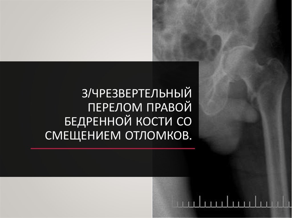 Перелом правого. Чрезвертельный оскольчатый перелом. Чрезвертельный перелом правой бедренной кости. Закрытый чрезвертельный перелом правой бедренной кости. Чрезвертельный перелом бедра со смещением.