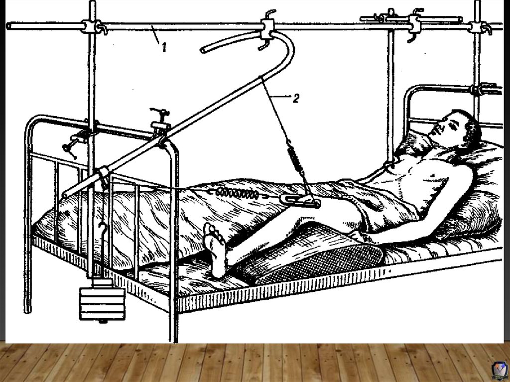 Скелетное вытяжение. Скелетное вытяжение при переломе вертельной зоны бедра. Система скелетного вытяжения шина Беллера. Вытяшение при переломов шейки бедра. Скелетное вытяжение за надмыщелки бедра.