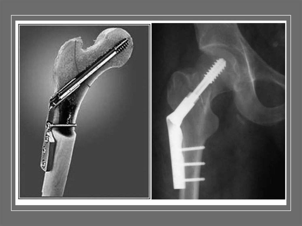 Перелом винта операция. Перелом шейки бедра остеосинтез. DHS пластина остеосинтез бедра. Внутрикостный остеосинтез шейки бедра. Пластина ДБВ остеосинтез.