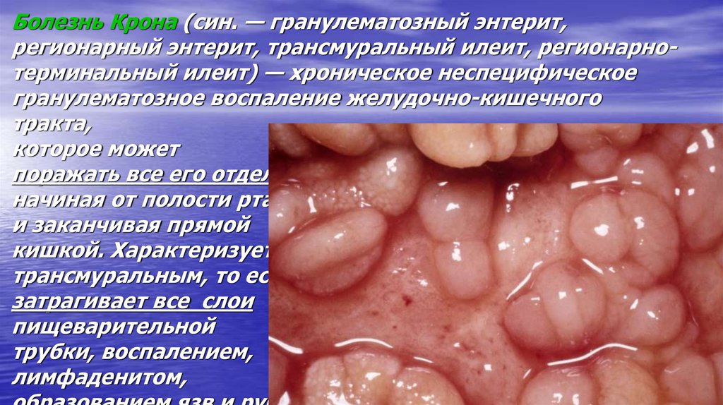 Неспецифический язвенный колит фото