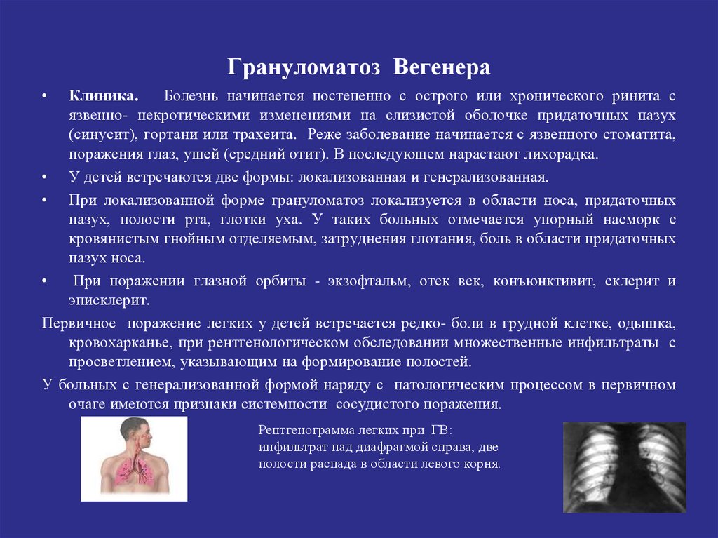 Заболевание началось. Гранулематоз Вегенера клиника. Гранулематоз Вегенера нос. Болезнь Вегенера клиника. Болезнь Вегенера у детей.