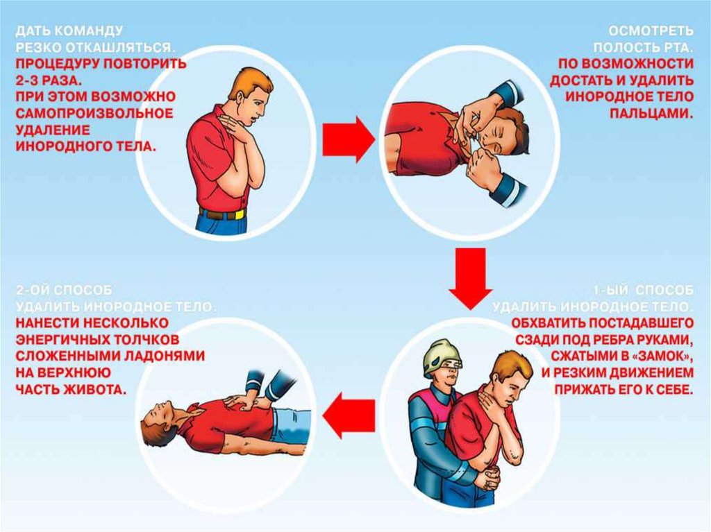 Первое помощь при асфиксия. Оказание первой медицинской помощи при удушье. Удушение меры первой помощи. Оказание первой медицинской помощи при подавился. Первая помощь при удушении человеку.