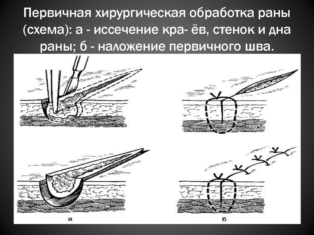 Чем обработать операции швы. Иссечение краев стенок и дна раны. Иссечение краёв стенок и дна раны это. Хирургическая обработка раны лица. Первичная хирургическая обработка РАН мягких тканей.