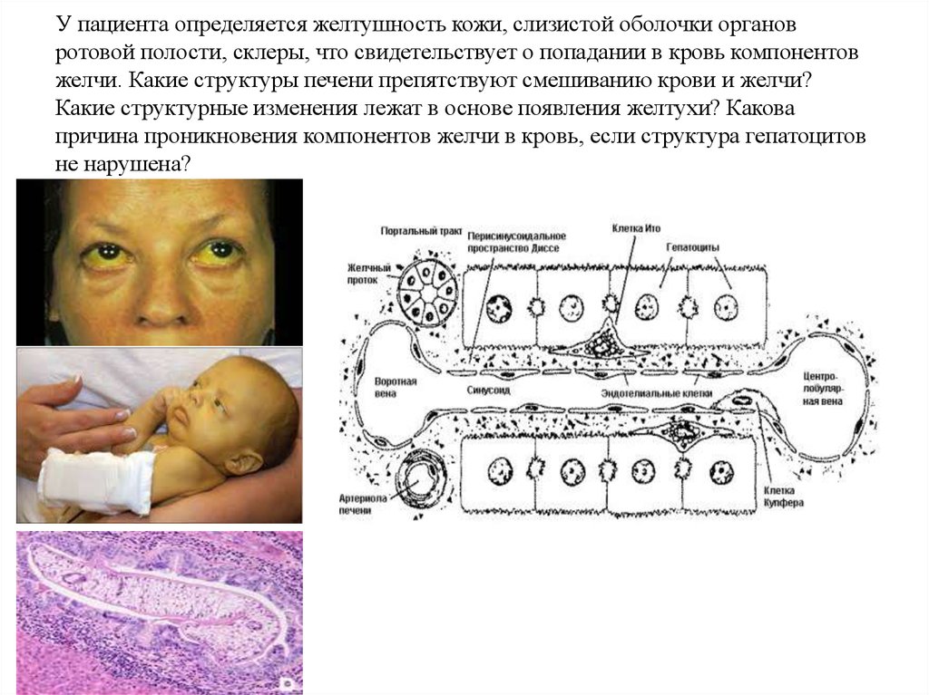 Пациент определить. Желтуха ротовая полость. Полость рта при желтухе. Ротовая полость при желтухе. Желтушность слизистой оболочки полости рта.