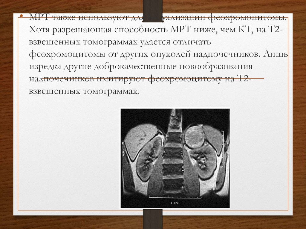 Феохромоцитома у детей презентация