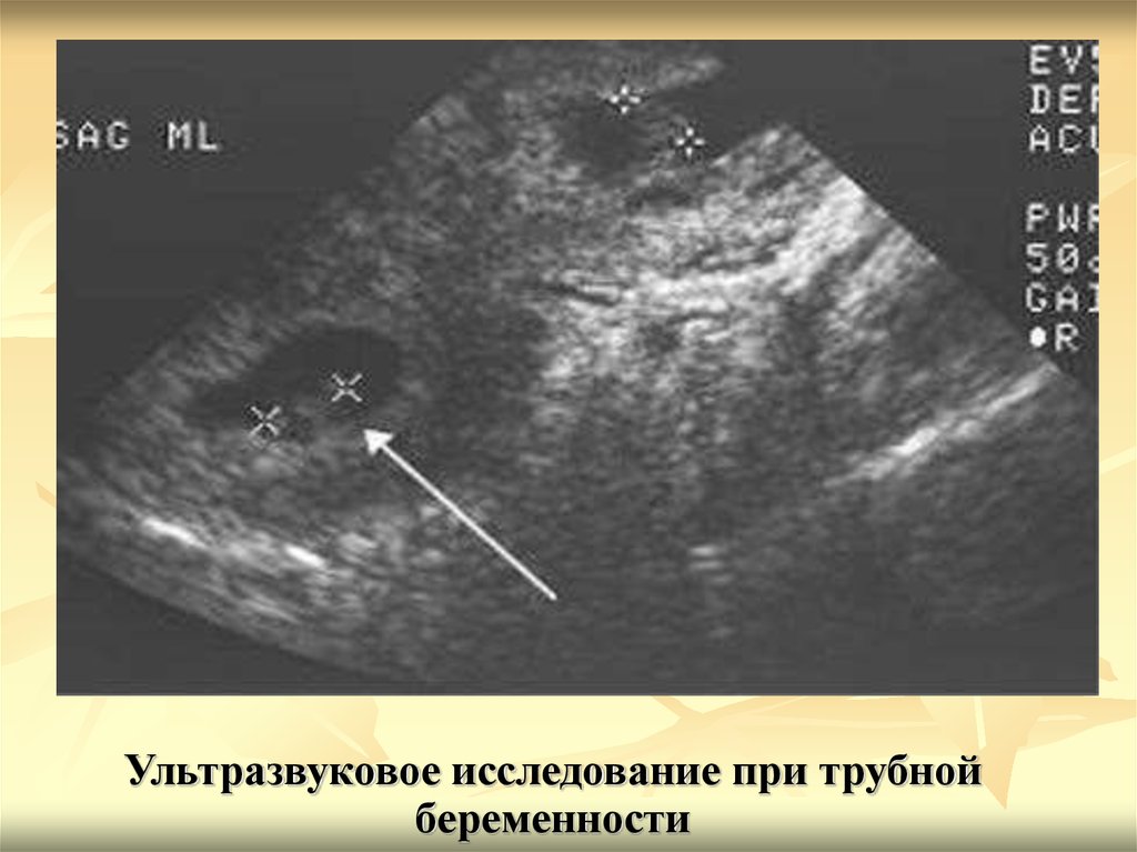 Когда на узи видно беременность на ранних. Внематочная Трубная беременность УЗИ. Ультразвуковое исследование беременности на ранних сроках. Внематочная беременность в трубе УЗИ. УЗИ внематочной беременности на раннем сроке.