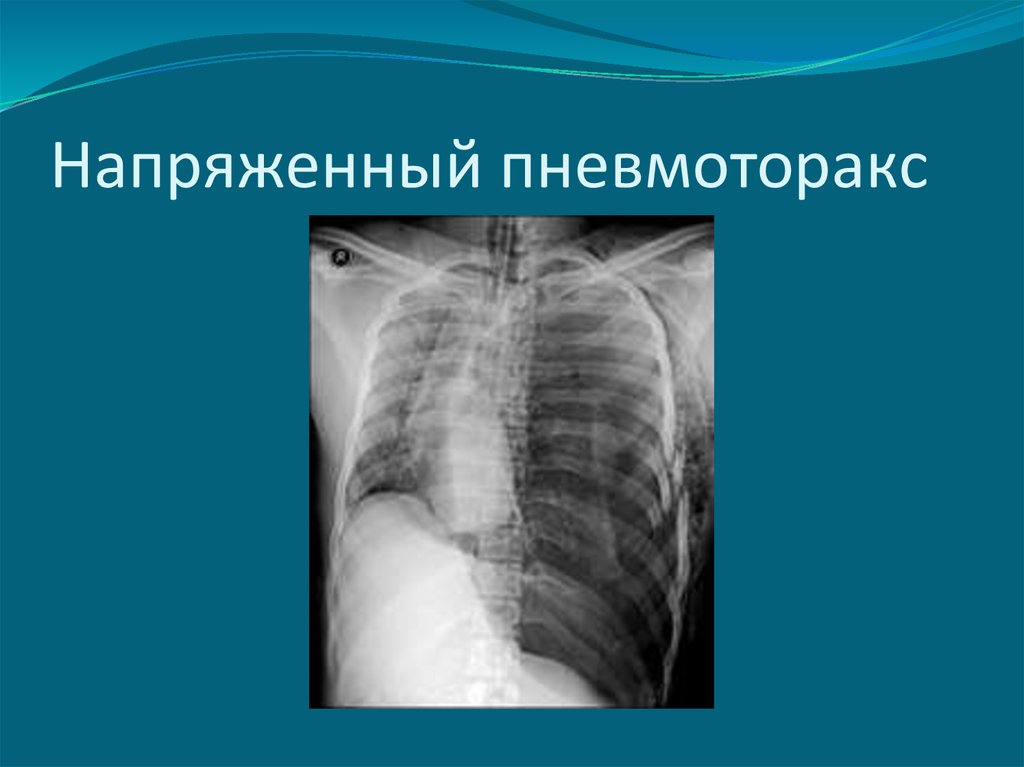 На рентгенологической картине напряженного пиопневмоторакса отмечается смещение средостения в