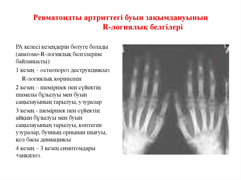 Буын синдромы презентация