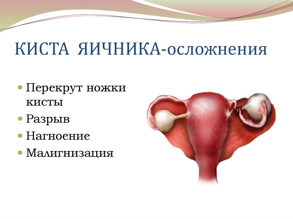 Причины разрыва яичника у женщин. Перекрут кисты яичников. Перекрут кисты маточных труб. Осложнения кист яичников. Киста яичника осложнения.