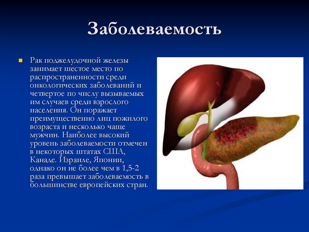 Симптомы рака поджелудочной у мужчин признаки. Ракьподжелудочной железы. Опухоль поджелудочной железы. Раковая опухоль поджелудочной железы. Онкология поджелудочной железы.