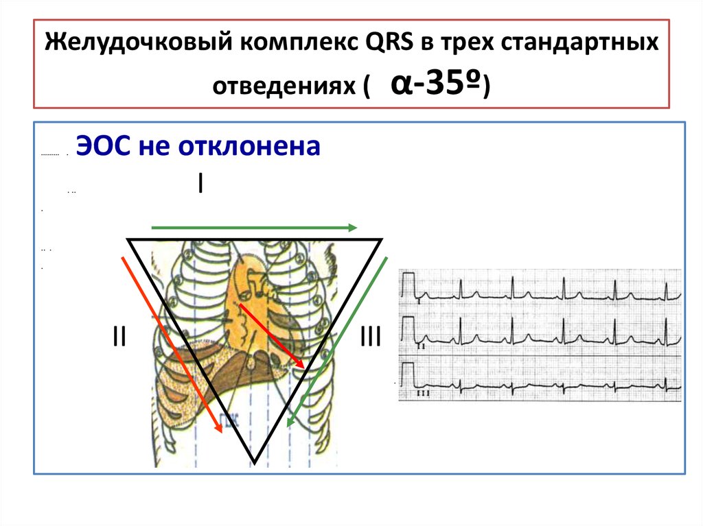 Желудочковый комплекс QRS в трех стандартных отведениях ( α-35º)