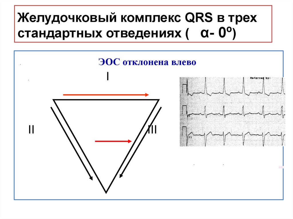 Электрическая ось сердца отклонена влево. Электрическая ось QRS. QRS В 3 стандартном отведении. ЭОС влево отведения. Комплекс QRS И ЭОС.