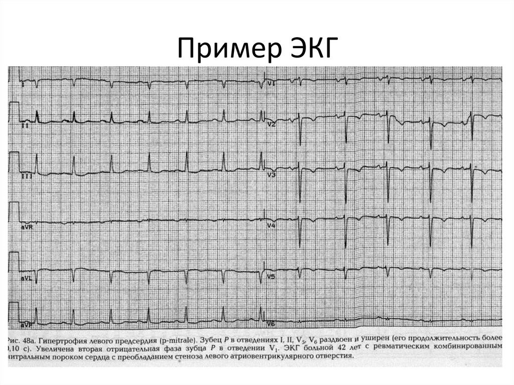 Нормальная экг фото картинки