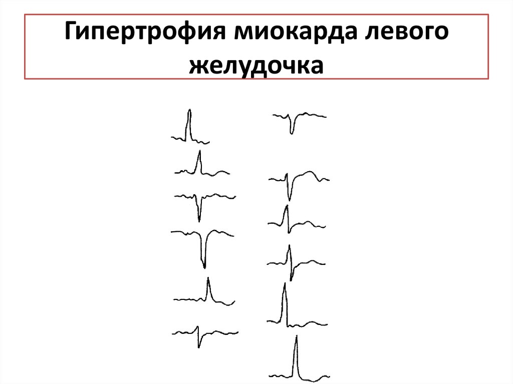 Гипертрофия миокарда рисунок