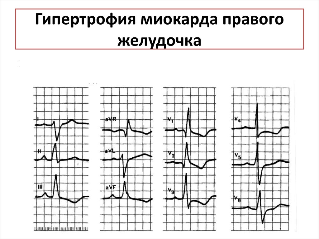 Гипертрофия правого желудочка. Гипертрофия миокарда правого желудочка. Синдром гипертрофии миокарда. Гипертрофия правого желудочка причины. Синдром гипертрофии правого желудочка.