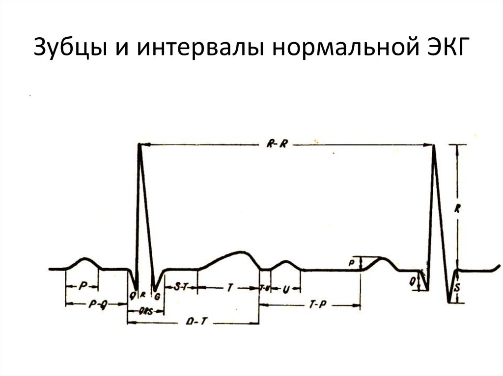 Экг рисунок с обозначениями