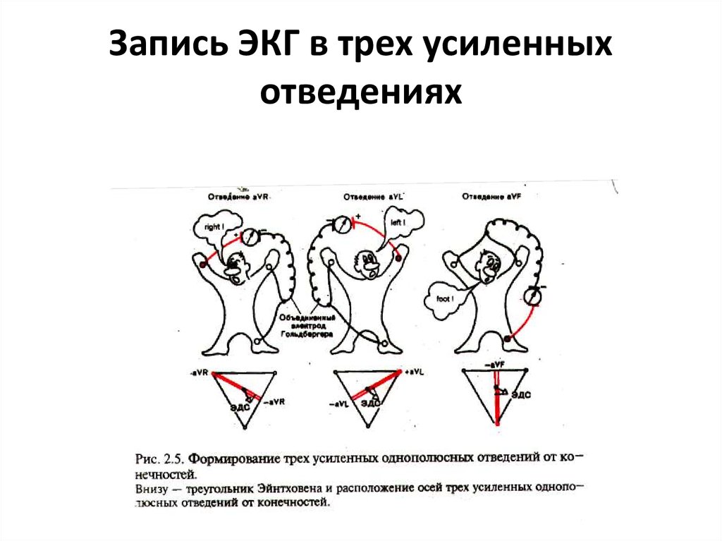 Запись ЭКГ в трех усиленных отведениях
