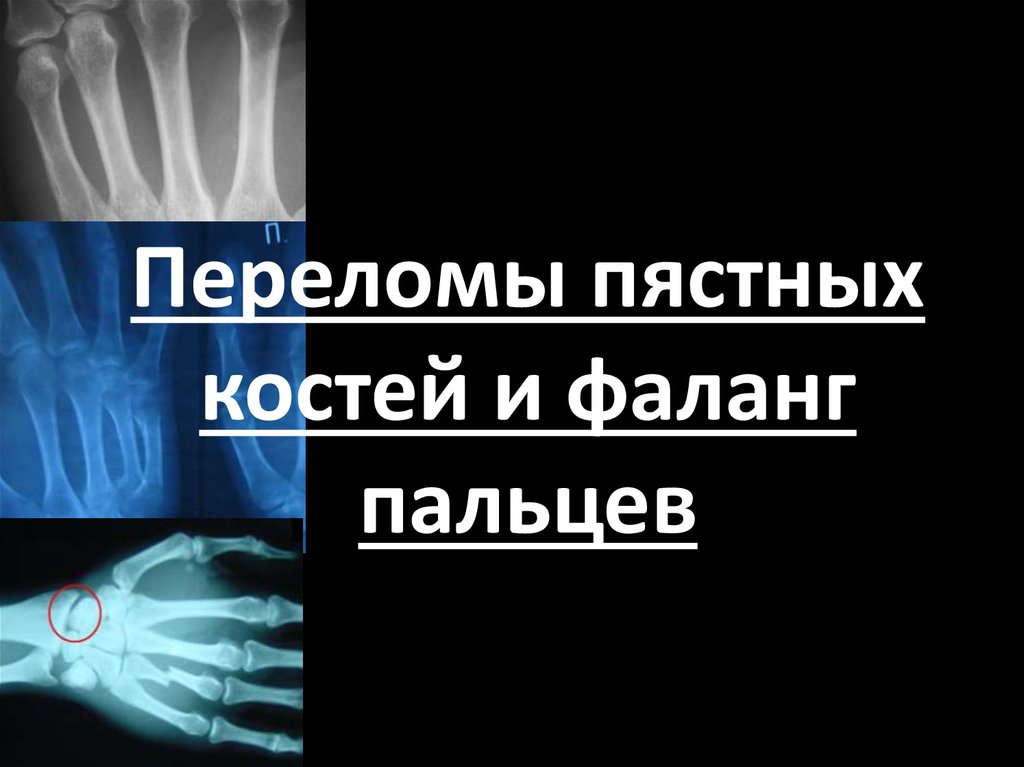 Переломы пястных костей кисти презентация Переломы пястных костей кисти презентация thumbnail