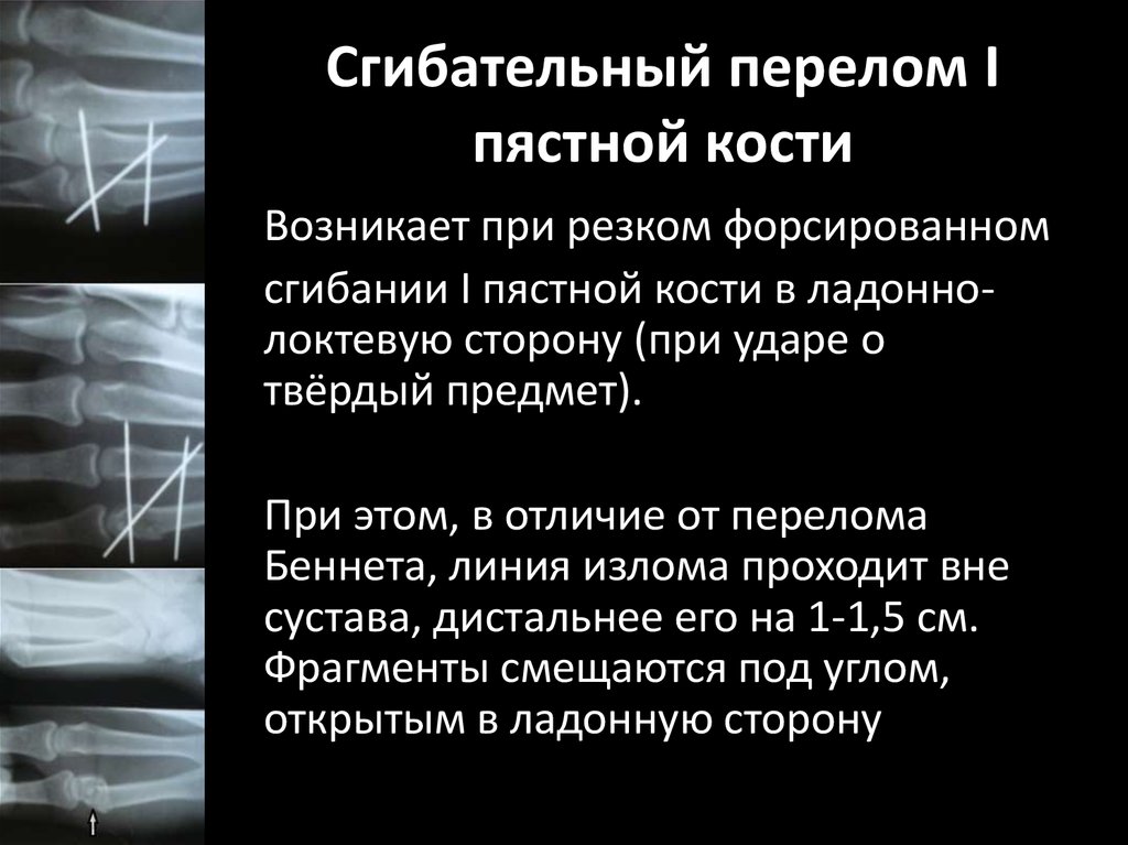 Сгибательный перелом I пястной кости