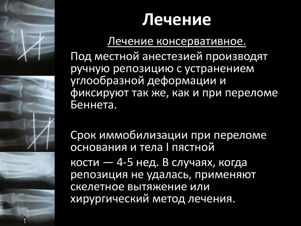 Лечение переломов костей. Иммобилизация при переломе пястной кости. Перелом Беннета репозиция.