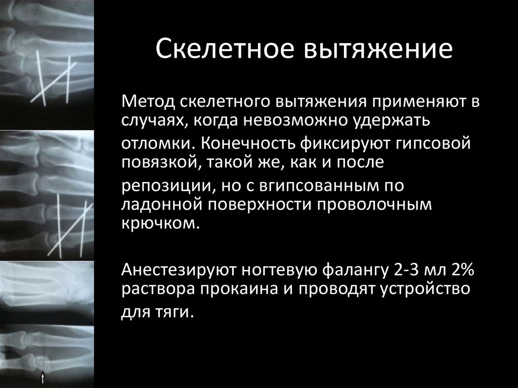 Скелетное вытяжение