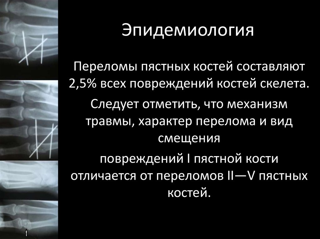 Тема сломать. Характер повреждения костей. Травмы костей кисти презентация. Эпидемиология повреждений мышц. Эпидемиология травм глаза.