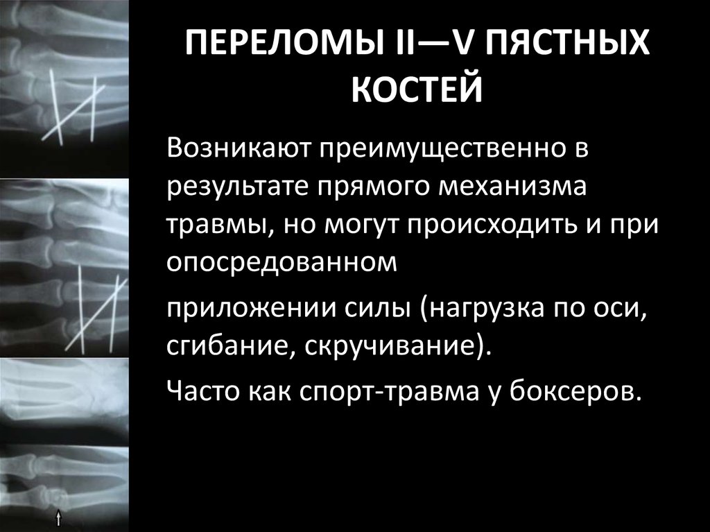 ПЕРЕЛОМЫ II—V ПЯСТНЫХ КОСТЕЙ